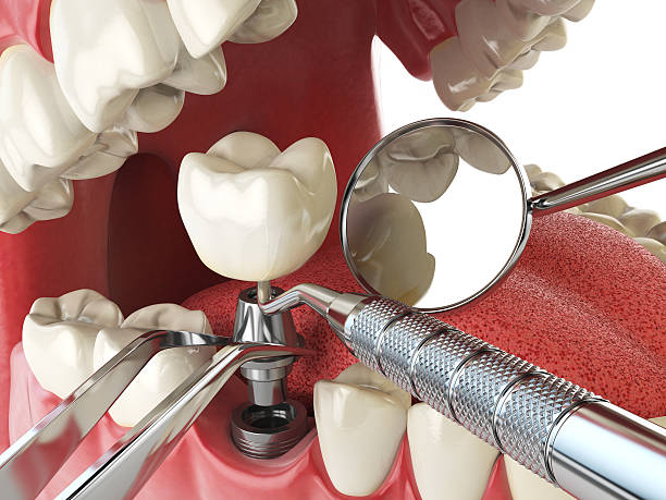 Best Knocked-Out Tooth Emergency  in Mesita, NM
